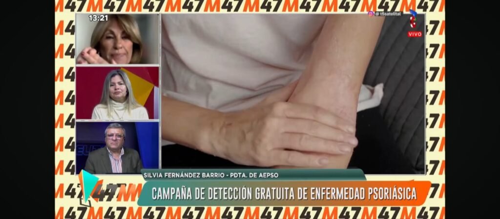 Corrientes se suma a una campaña nacional para detectar la artritis psoriásica con consultas gratuitas